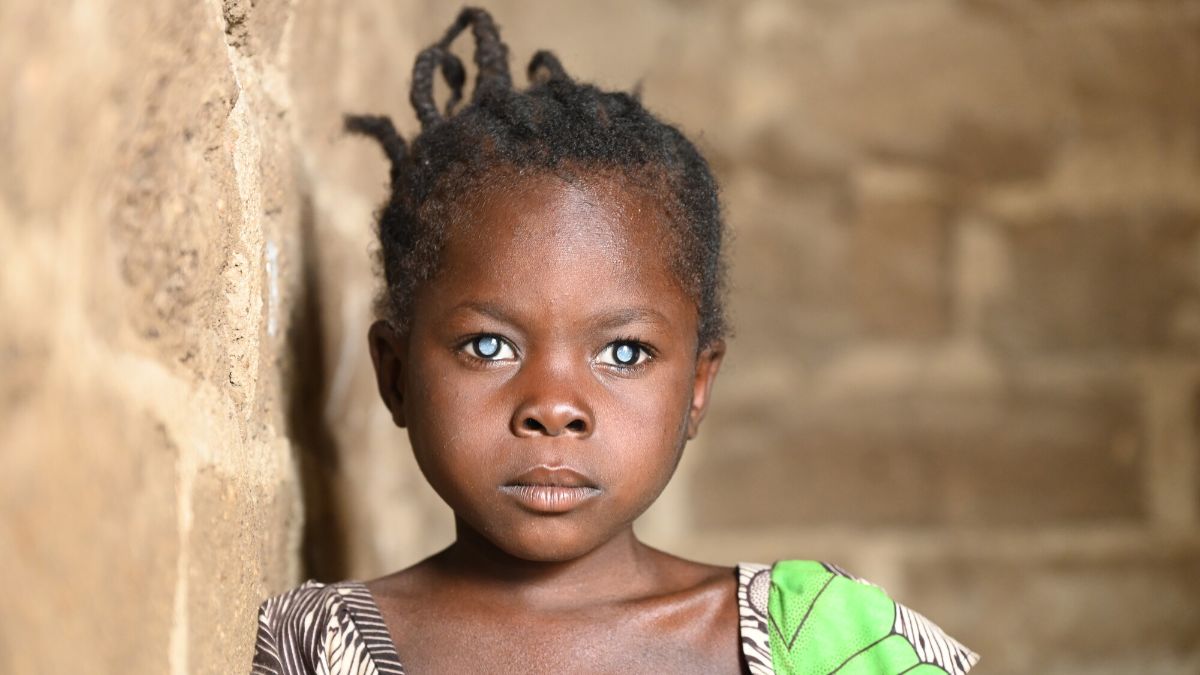 Ein Mädchen, auf dessen Augen ein grauer Schleier zu sehen ist.