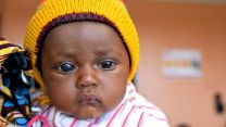 Baby mit einem stark vergrößerten Auge