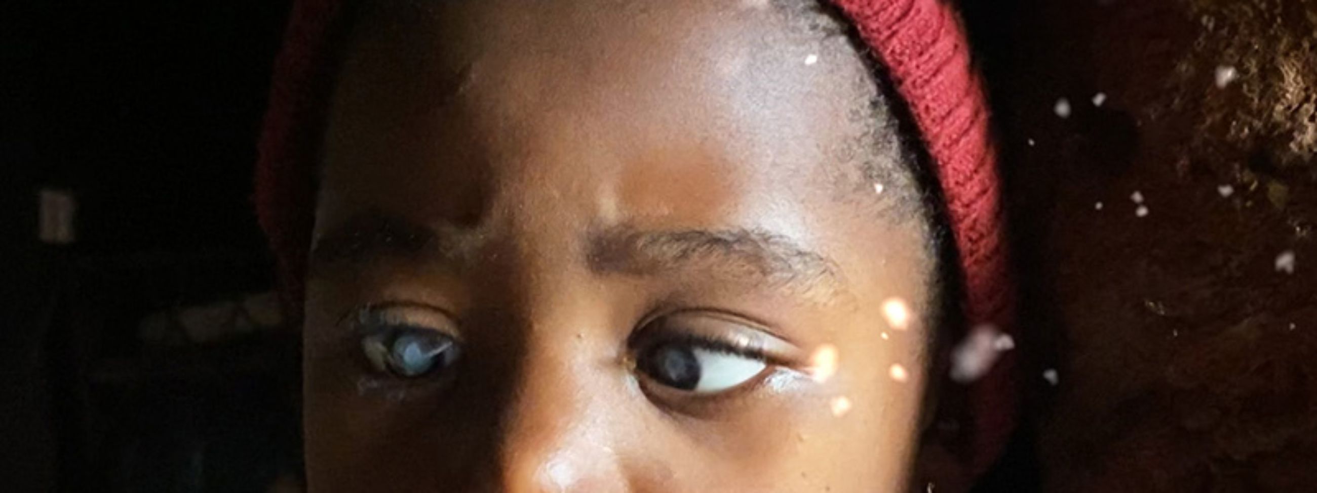 Eine halbseitliche Aufnahme von einem Mädchen namens Kindra. In ihren Augen erkennt man deutlich den Grauen Star.