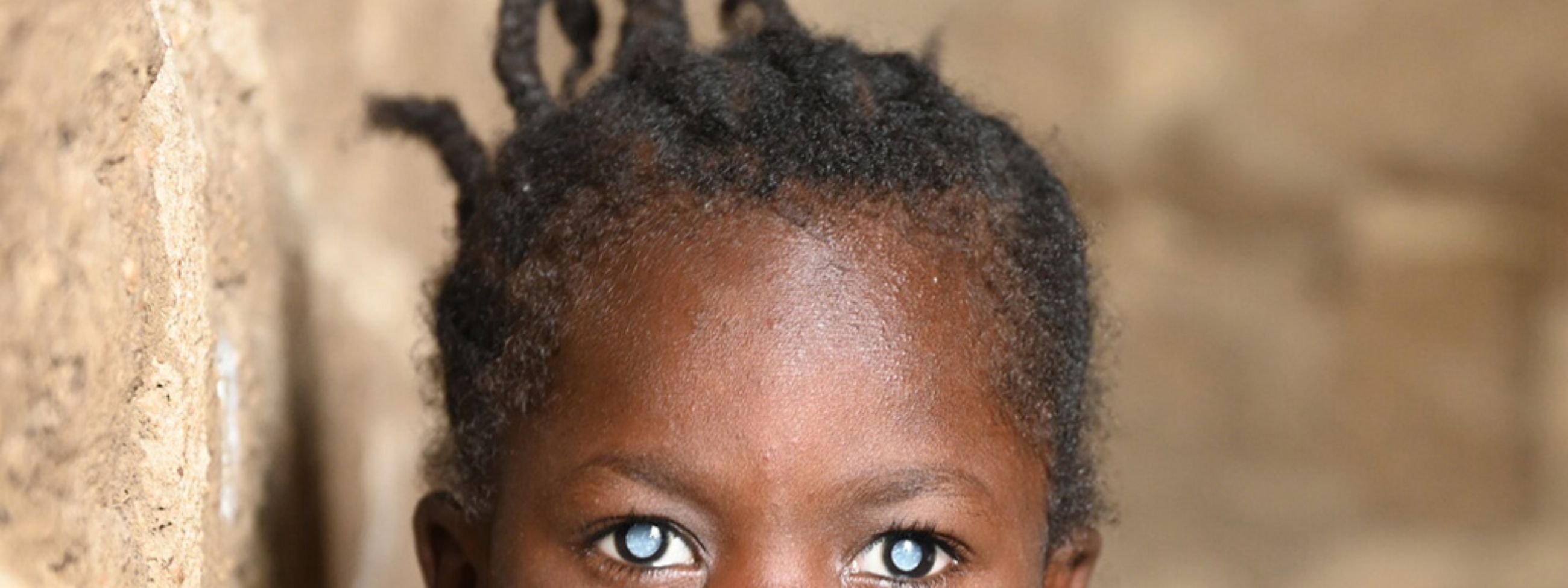 Ein kleines Mädchen mit weißen Pupillen.