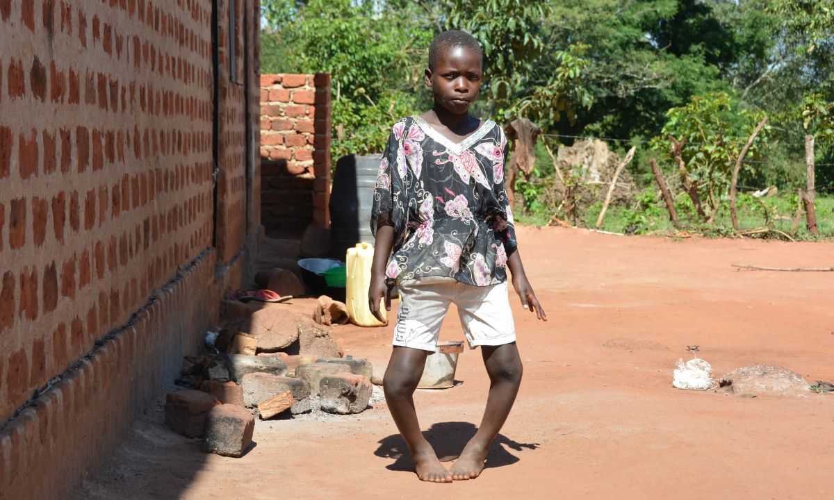 Afrikanisches Mädchen mit extremen O-Beinen